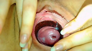 Shy cervix